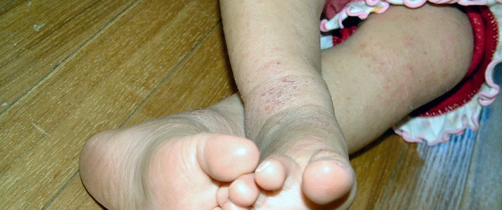 アトピー性皮膚炎子供の写真